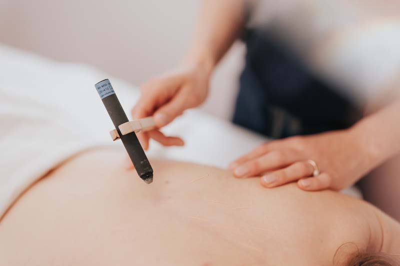 acupuncture - moxibustion